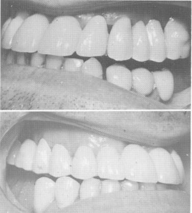5 Maxillary prosthesis with gold acrylic veneer, porcelain fused to metal