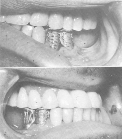 1 Lower veneer crown castings are to meet remaining interocclusal space