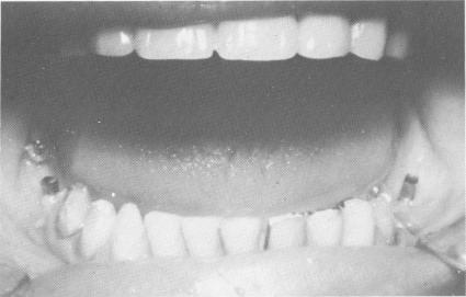 2 Bilateral lower endosseous vent-plant implant in posterior area