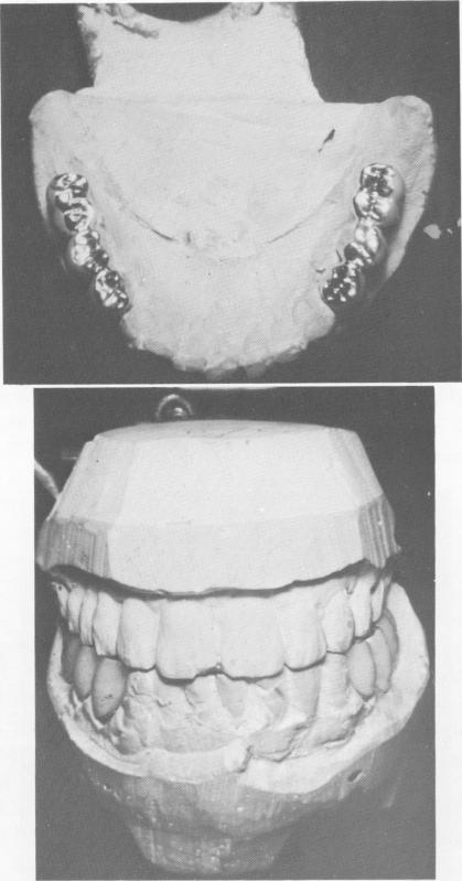 3 Bilateral fixed partial lower vent plant implant dentures completed