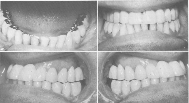 1 Case shows the elimination of the Class III malocclusion