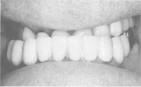 2 Class III severe cross bite, upper and lower blade implant intervention