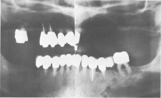 1 Preoperative panorex before upper and lower blade implant intervention