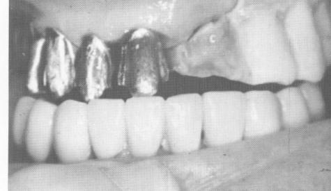 2 Metal copings are cast and fitted over upper teeth on right side