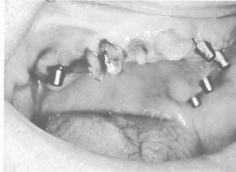 3 Blade implants are implanted on both sides of the maxillary arch