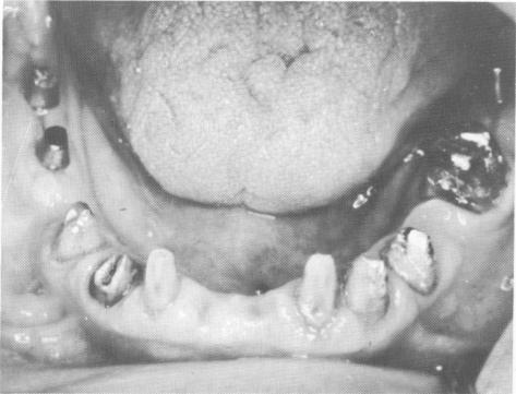 4 Lower teeth prepared, blade-vents implants placed in edentulous areas