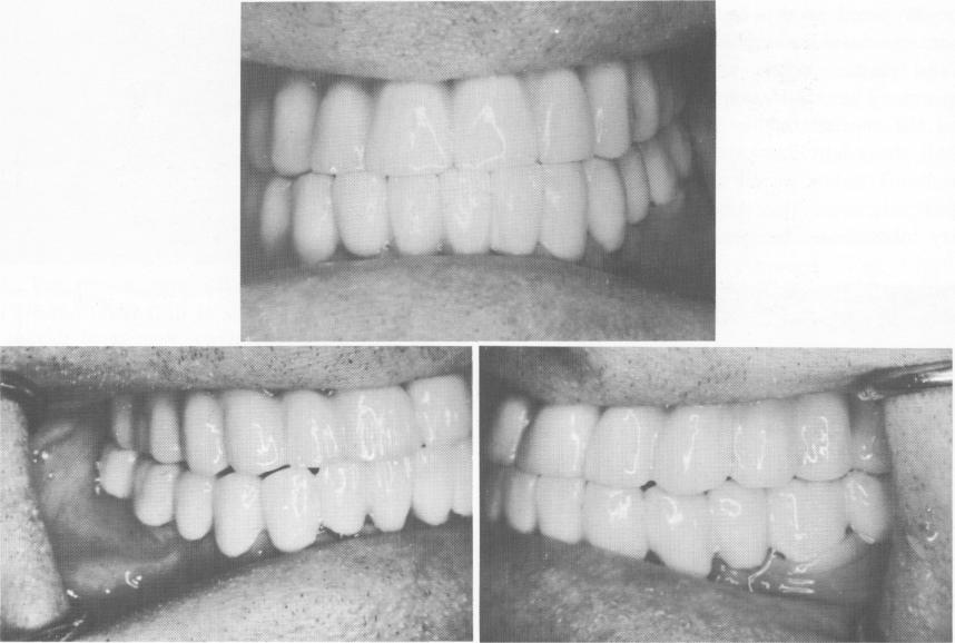 1 Case shows  teeth in Class I relationship after blade implantation
