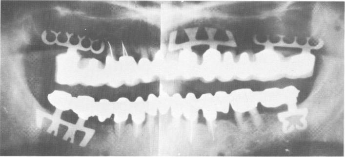 2 Final panorex of endosseous upper and lower blade implants in position
