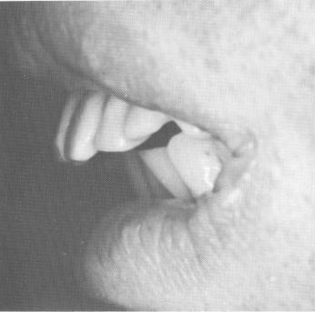 1 Patient exhibits extreme overjet and flared upper anterior teeth