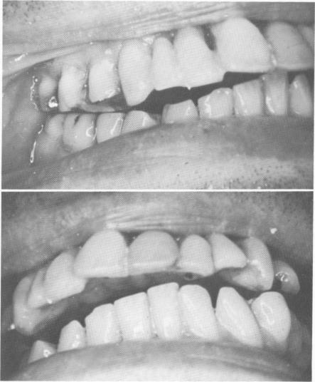 2 Asymmetry of maxillary and mandibular arches clearly visible
