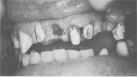 3 Upper anterior teeth, lower posterior teeth prepared for restorations