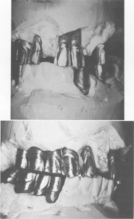 4 Upper and lower master casts show metal coping in position over die