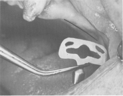 2 Well designed endosseous blade implant inserted in maxillary groove