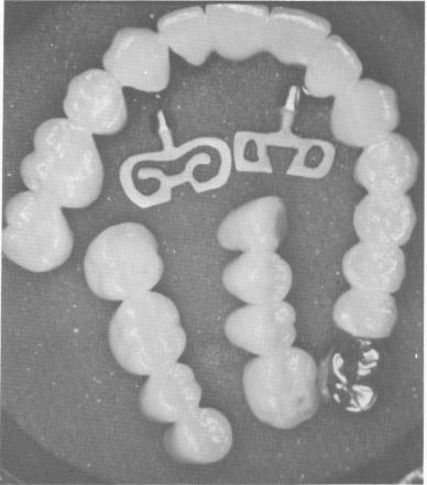 3 View of porcelain-fused-to-metal prostheses,endosseous blade implants