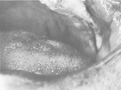 4 Incision along fibromucosal tissue at crest of  maxillary ridge