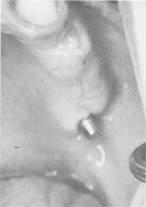 5 Uneventful healing after insertion of upper endosseous blade implant