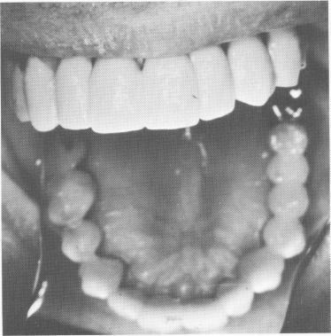 1 Upper endosseous blade implant prosthesis cemented 