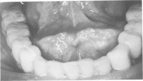 2 Mandibular partial dentures are cemented into position