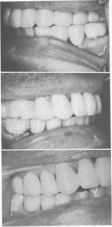 3 Occlusion and overjet improved after endosseous blade implantation
