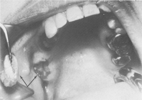 1 Fibromucosal tissue near lower molar removed surgically