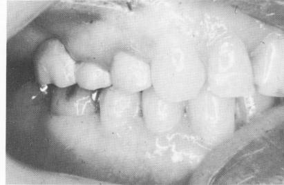 2 Faulty fixed partial denture with two bicuspids, cantilevered molar