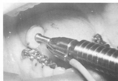 3 Occlusal surface of last molar inlay reduced