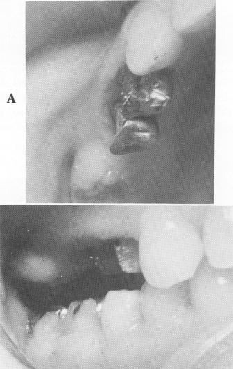 1 Space created to include upper endosseous pin implant and second molar