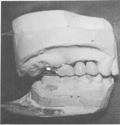 2 Prefabricated unilateral four-unit veneer pin implant bridge on model
