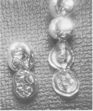 3 Scalloped template and two-unit upper pin implant superstructure 