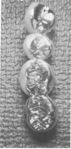 1 Two-unit molar superstructure fit over pin implant template