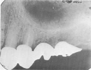 2 Xray of second premolar root touching floor of maxillary sinus