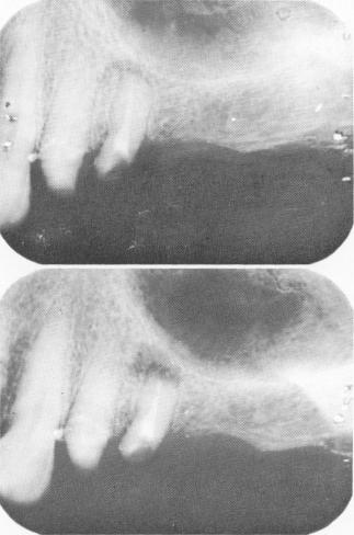 3 Apicectomy on root tip creates space between it and antral floor