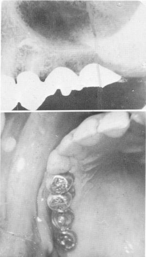 4 Xray of framework over template to determine pin implant position