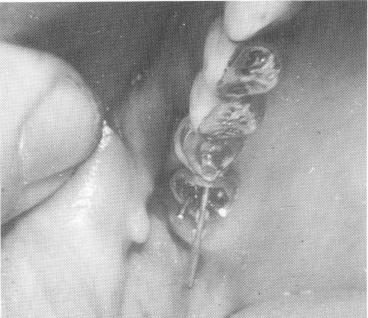 1 Endosseous upper pin implant driven through template anteroposteriorly