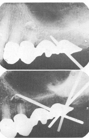 2 Periapical radiograph shows endosseous pin implants in position