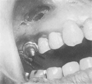 3 Endosseous pin implants extend through scalloped template in maxilla