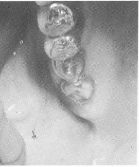 4 Acrylic locks upper pin implants  to each other and to template