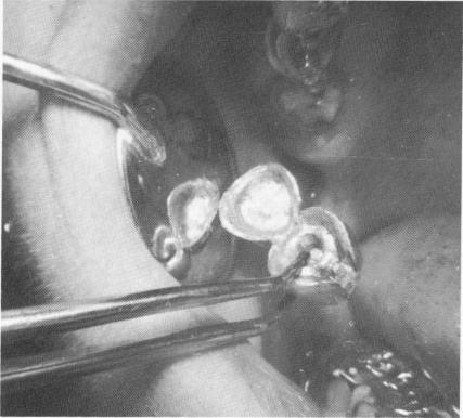 1 Implant superstructure cemented on acrylic core, gold post on template