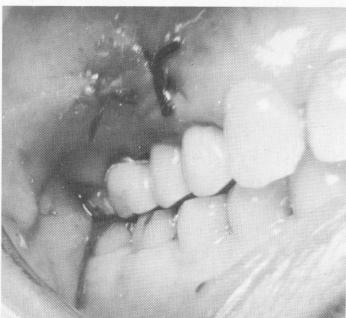 2 Occlusion checked after upper endosseous pin implantation