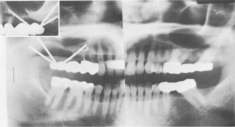 3 Panorex and intraoral xray after upper endosseous pin implantation