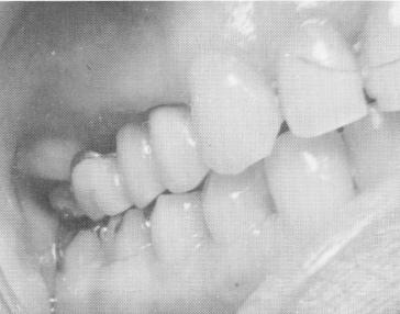 4 Excellent tissue healing after endosseous pin implantation in maxilla