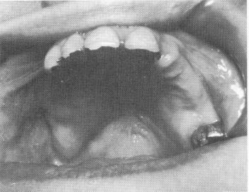 1 Resorbed maxillary ridge in right posterior quadrant region