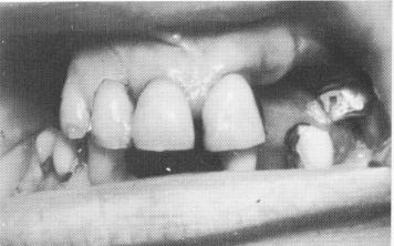 3 Lower right bicuspids extend far buccally than opposing upper ridge
