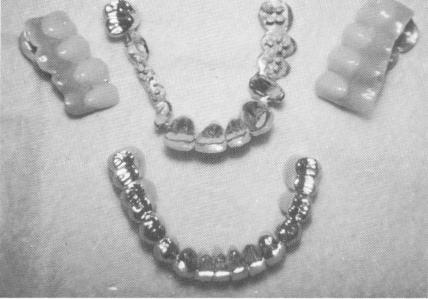 2 Lower arch acrylic-facinggold occlusal implant prosthesis fabricated