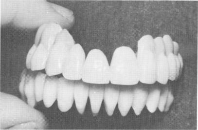 3 Maxillary pin implant superstructures fit over scalloped template