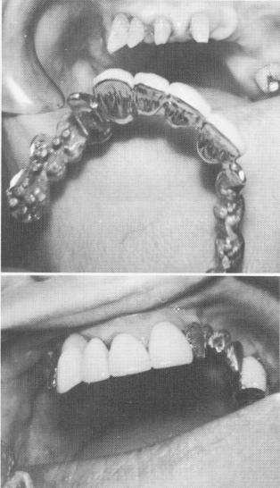 4 Maxillary implant prosthesis was cemented into position