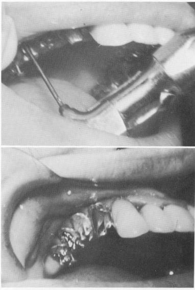 5 Pin implants carefully angulated to end deep in the zygomatic arch