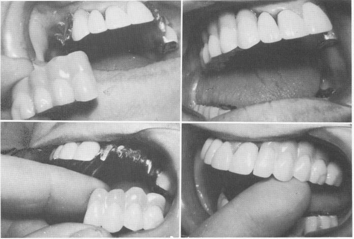 1 Endosseous pin implant superstructure try in