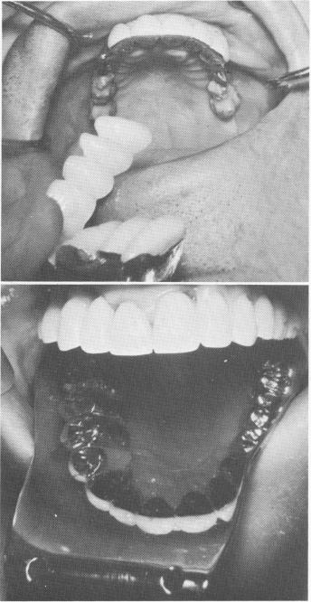 2 Pin implants fused with acrylic, super-structures cemented on template