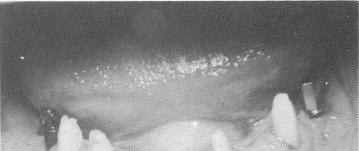 3 Pin implant posts placed in posterior edentulous areas in mandible